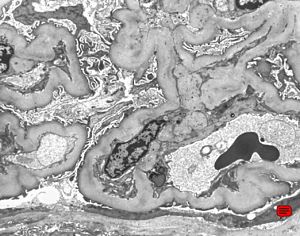 F,52y. | diabetic glomerulopathy